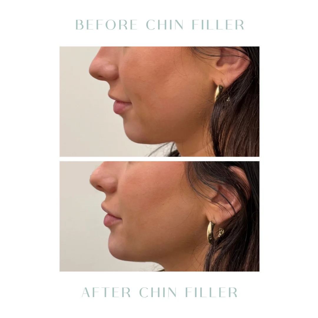 Before and after cheek Fillers in Charleston, SC
