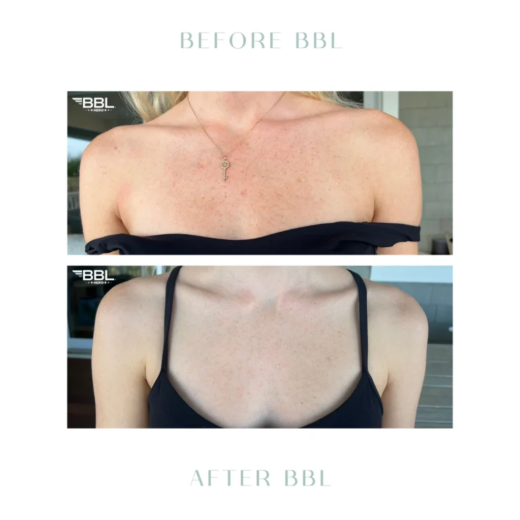 Before and after BBL Laser treatment in Charleston, SC