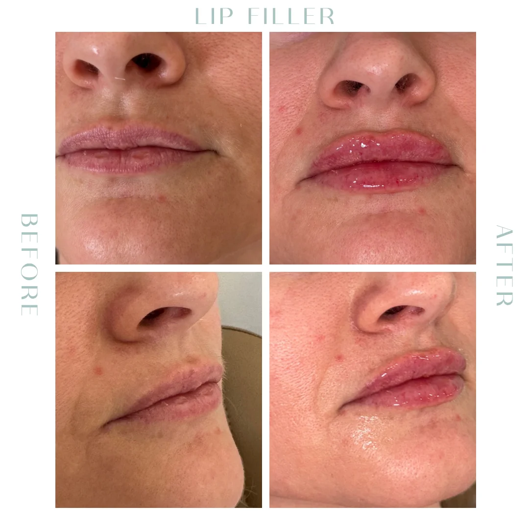 Before and after lip Fillers in Charleston, SC