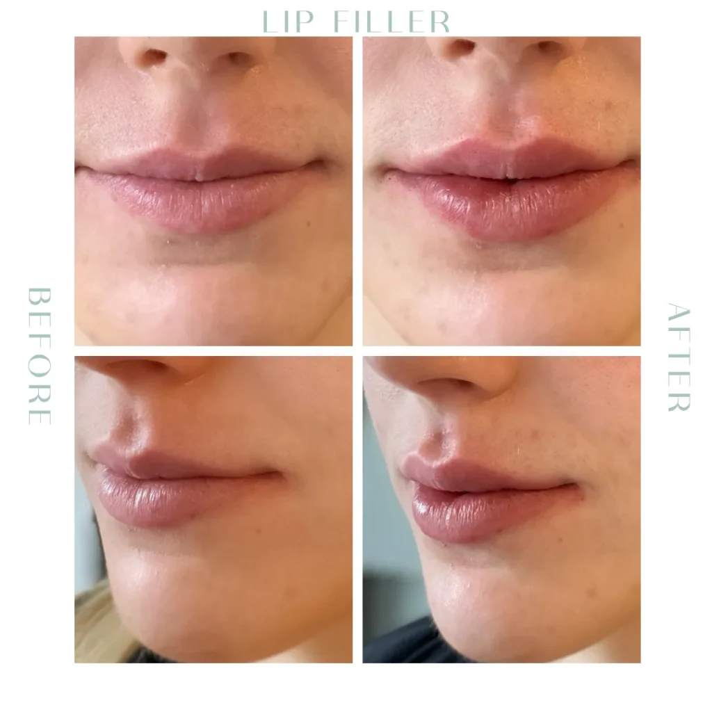 Before and after lip Fillers in Charleston, SC