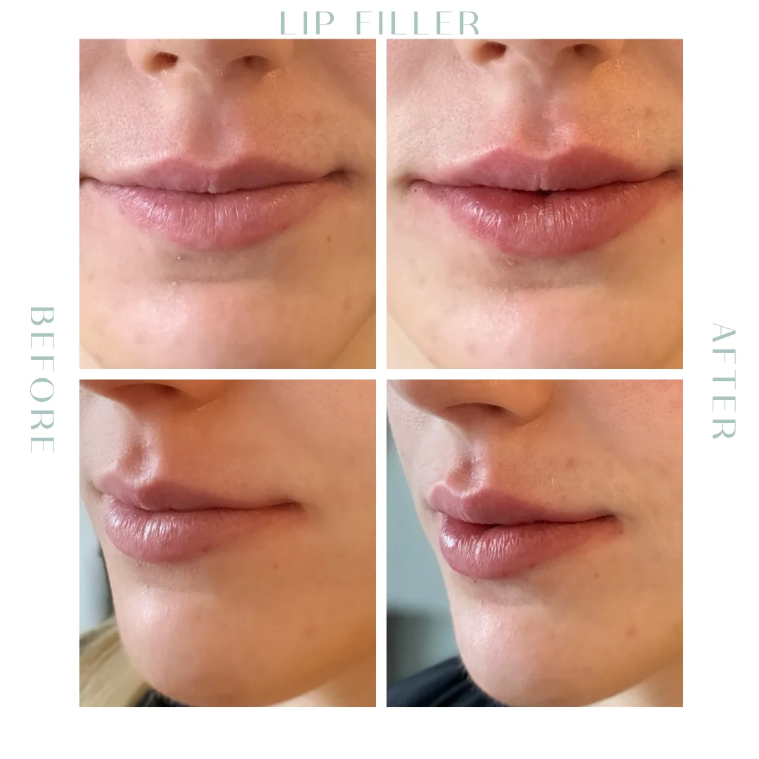 Before and after lip Fillers in Charleston, SC