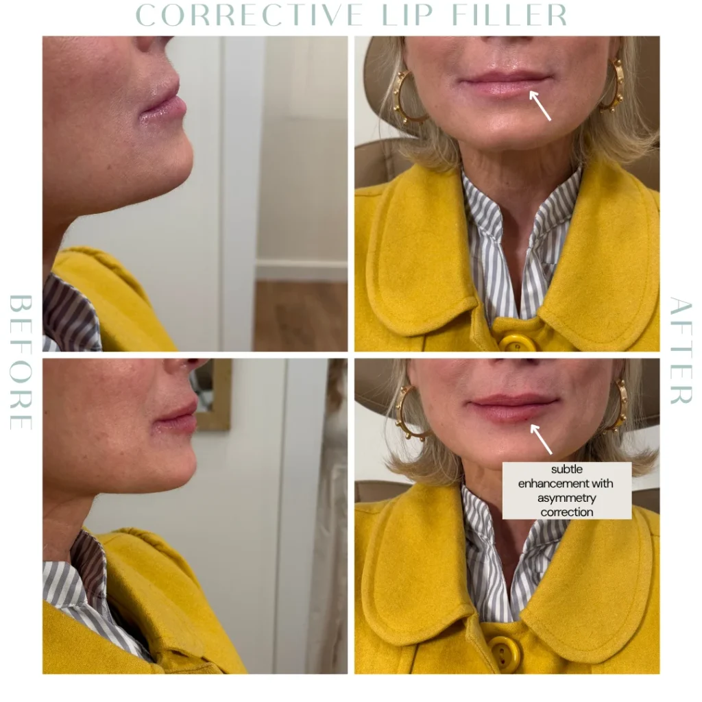 Before and after lip Fillers in Charleston, SC