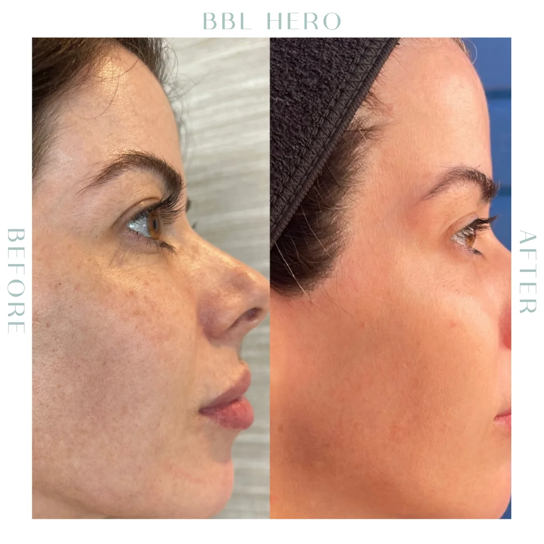 Before and after BBL Laser treatment in Charleston, SC