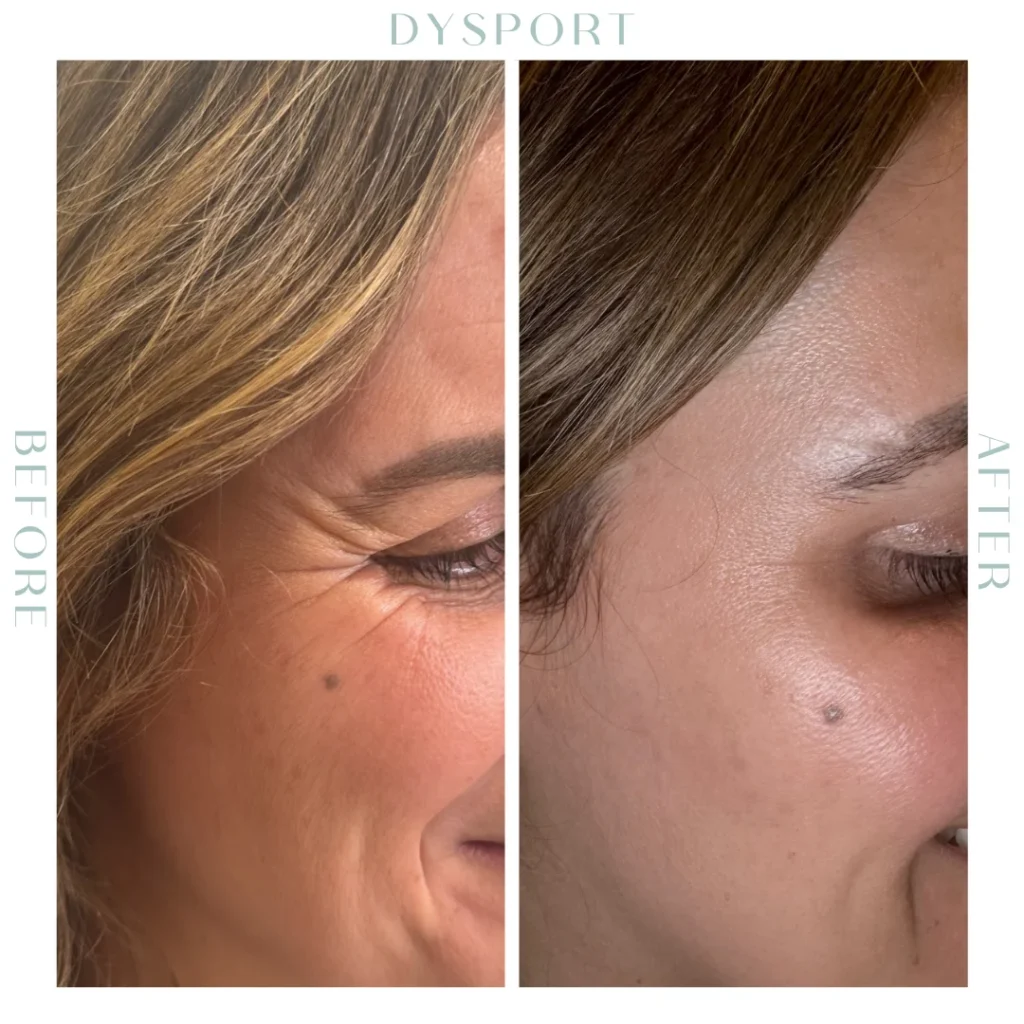 Before and after Wrinkle Relaxers in Charleston, SC | Botox & Dysport