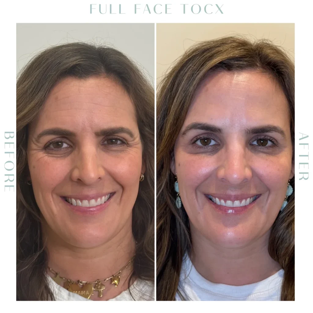 Before and after Wrinkle Relaxers in Charleston, SC | Botox & Dysport