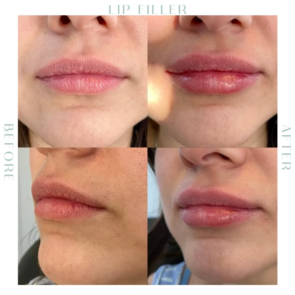 Before and after lip Fillers in Charleston, SC