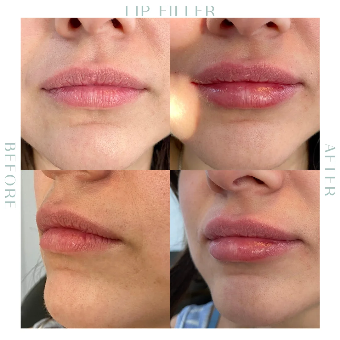 Before and after lip Fillers in Charleston, SC