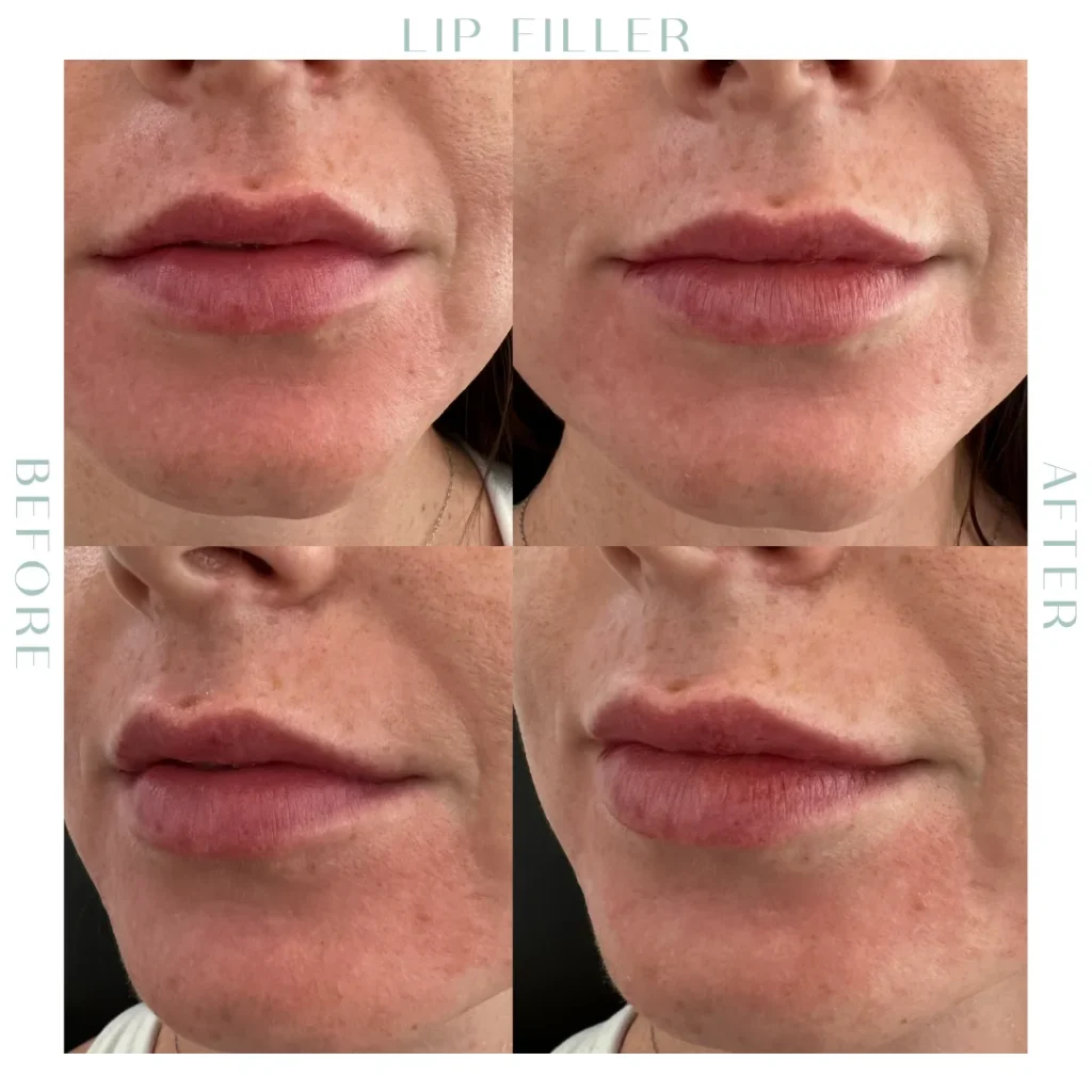 Before and after lip Fillers in Charleston, SC