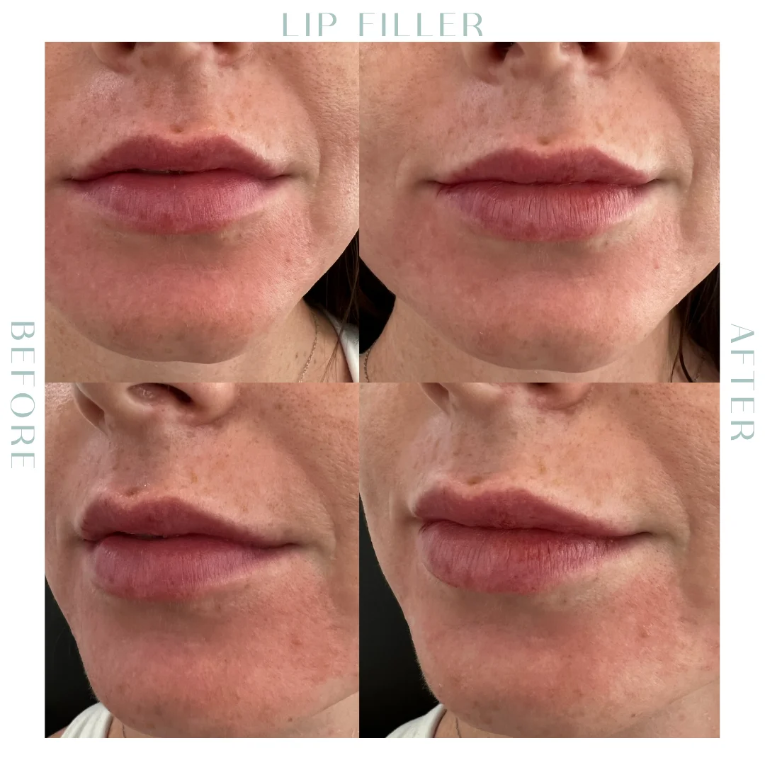 Before and after lip Fillers in Charleston, SC