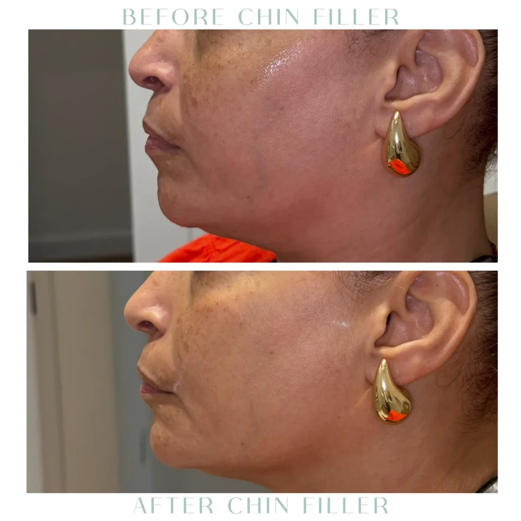Before and after cheek Fillers in Charleston, SC