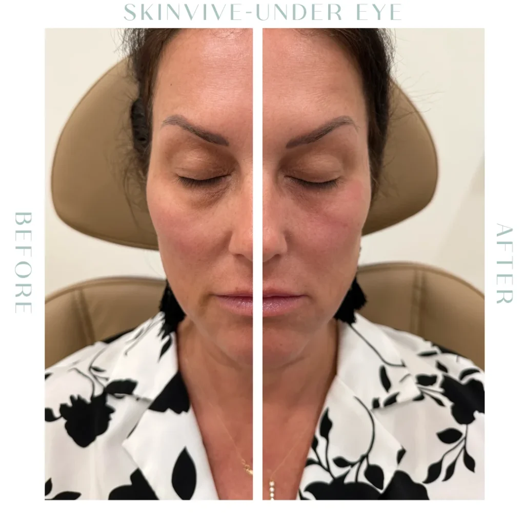 Before and after Skinvive Treatment in Charleston, SC