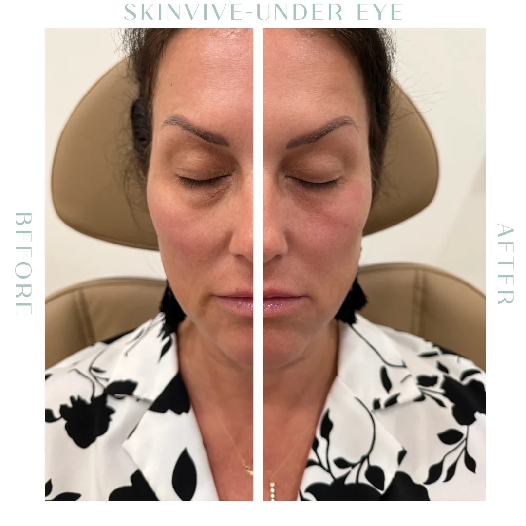 Before and after Skinvive Treatment in Charleston, SC