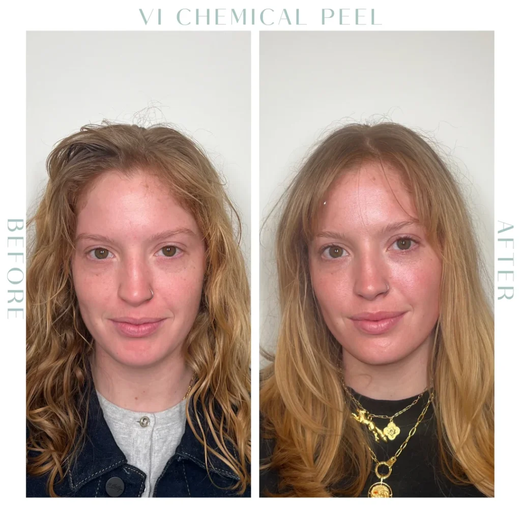 Before and after Chemical Peel