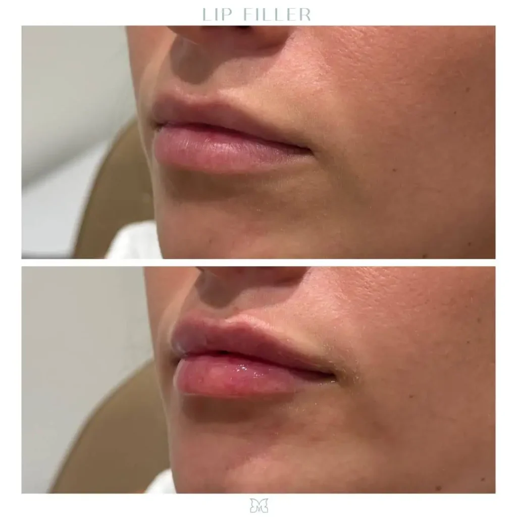 Lip filler