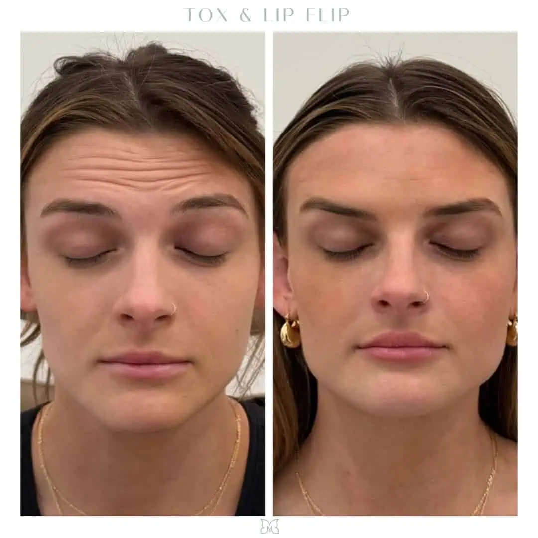 Tox & Lip Flip (1) (1)