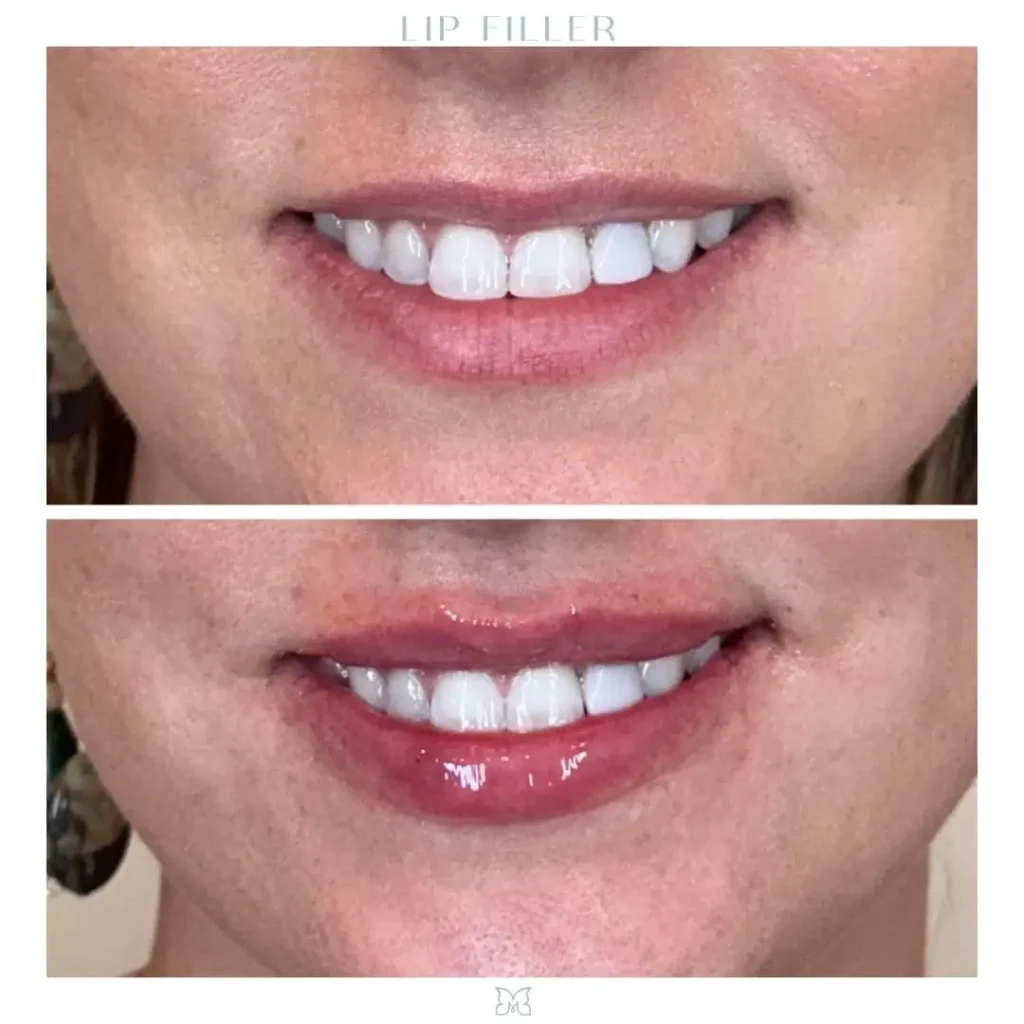 lip filler (1)