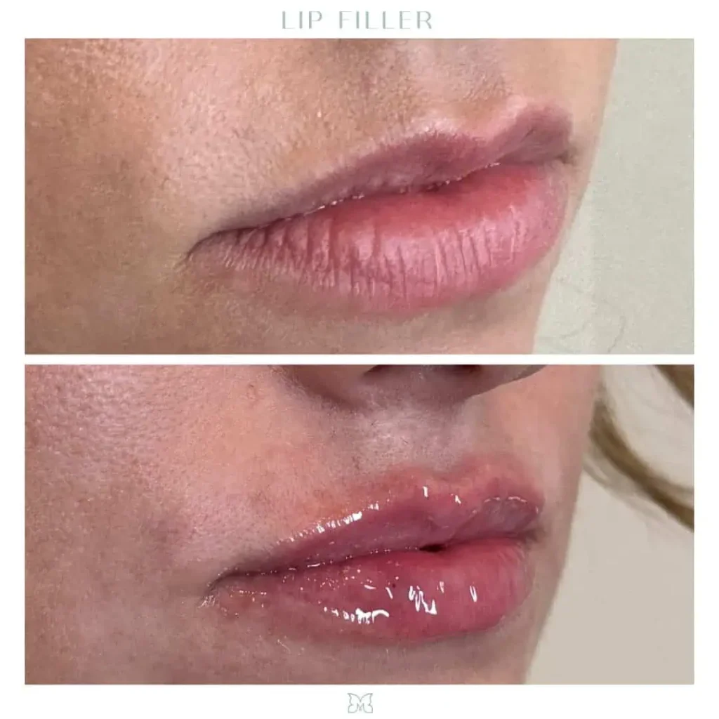lip filler (3)