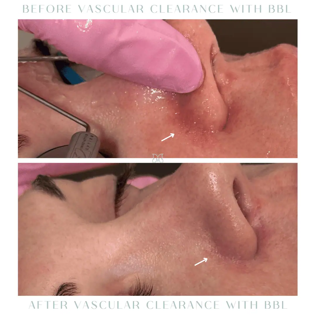 bbl-before-after-3-in-Charleston-SC