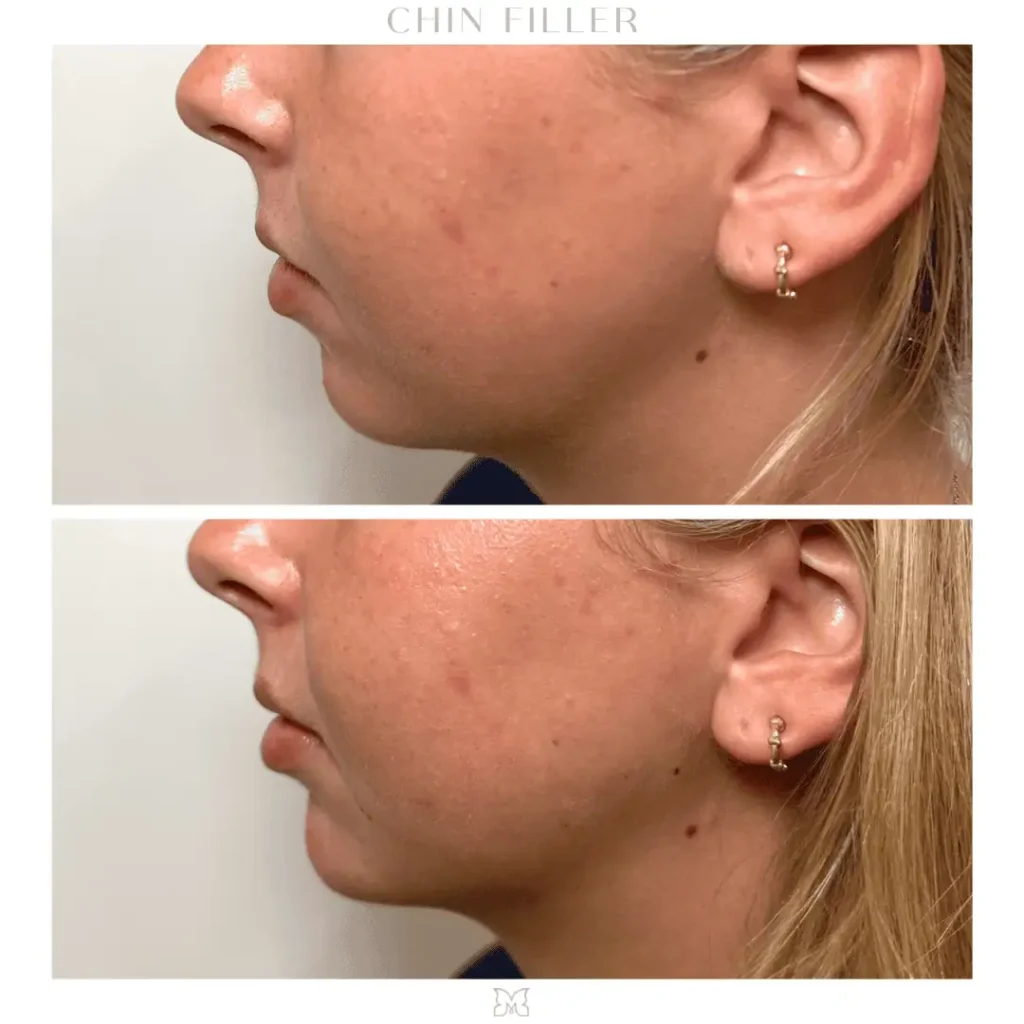 chin-filler-before-after-3-in-Charleston-SC