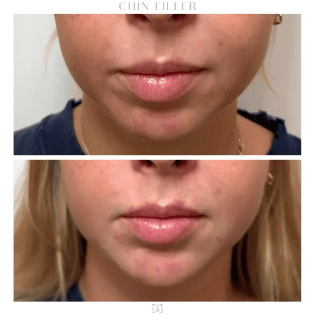 chin-filler-before-after-4-in-Charleston-SC