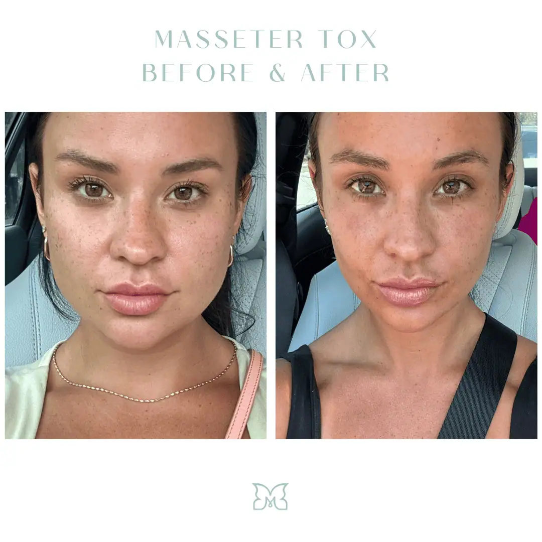 masseter-tox-before-after-2-in-Charleston-SC