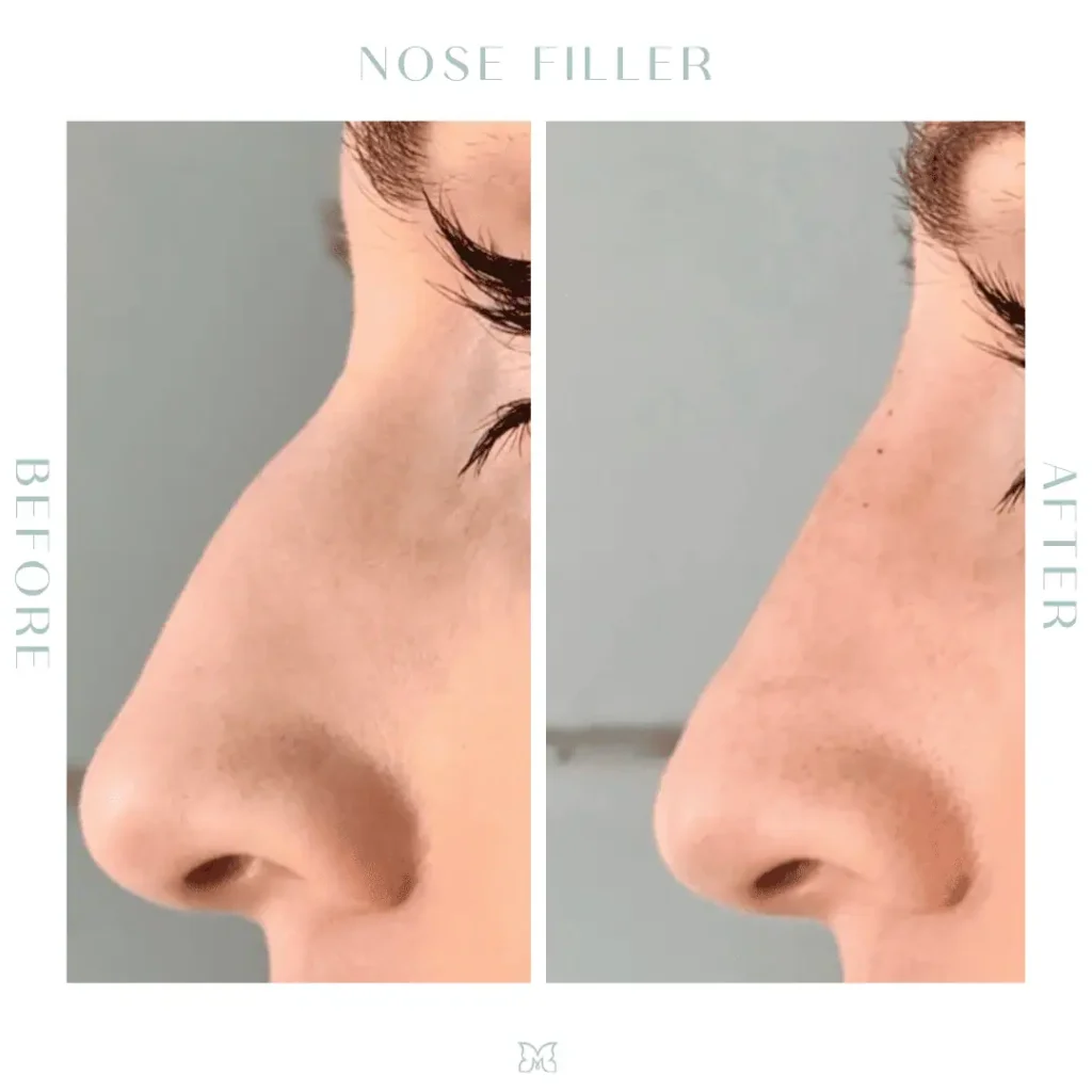 nose-filler-before-after-1-in-Charleston-SC