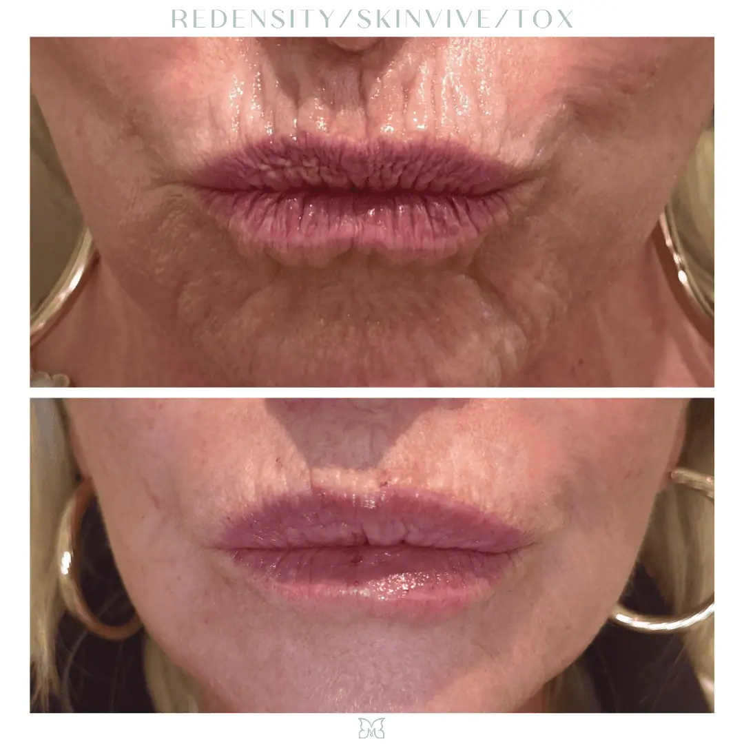 skinvive-before-after-2-in-Charleston-SC