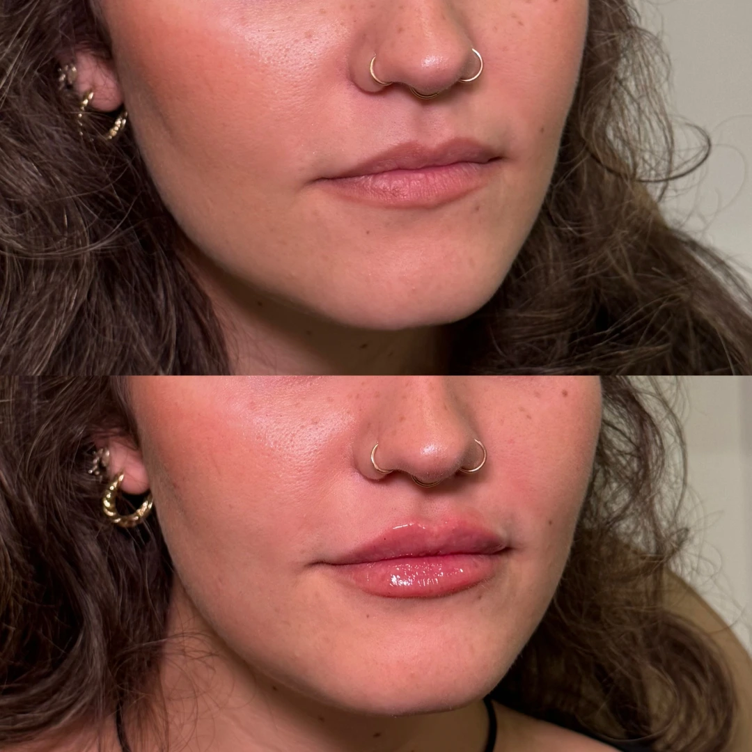 Lip Filler Before & After 1 (1)
