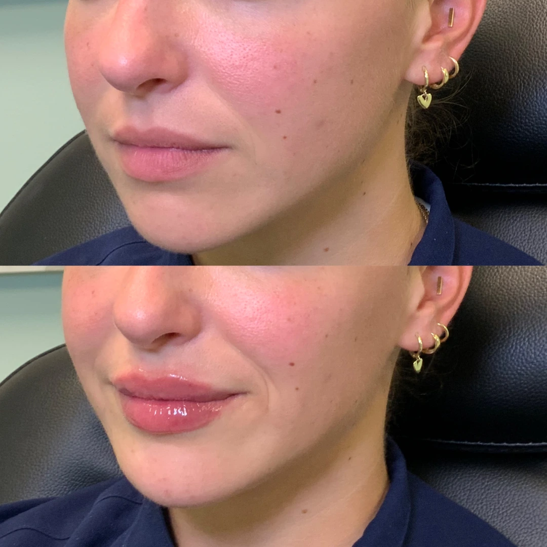 Lip Filler Before & After 2 (1)