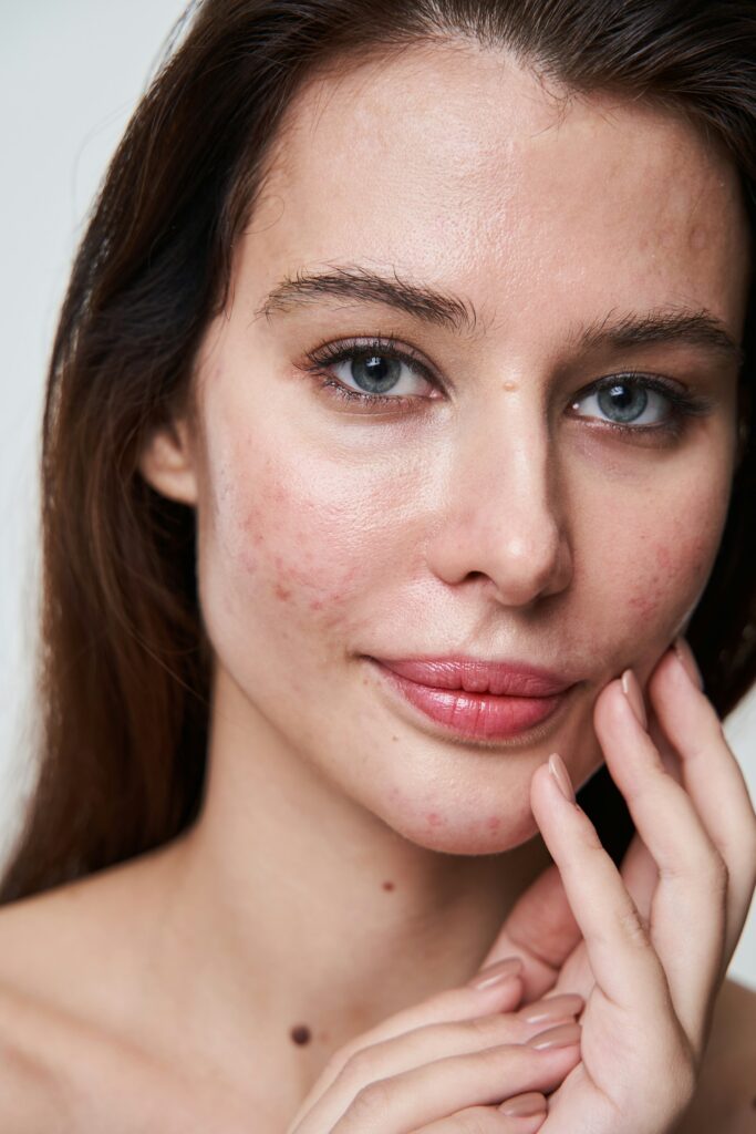 Best Treatments for Acne Scars in Charleston, SC